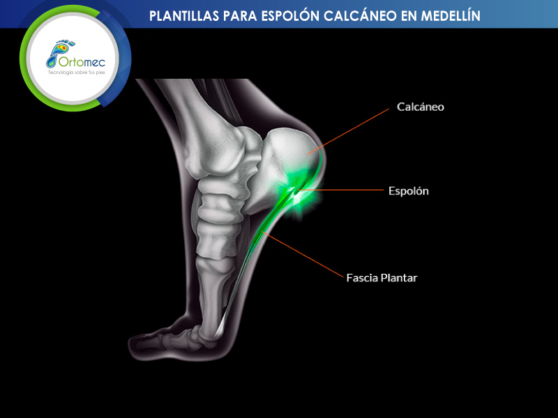 deportistas que necesitan plantillas para espolon calcaneo