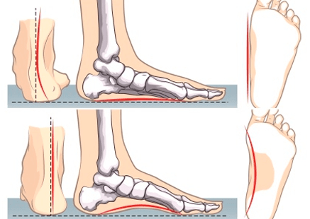 plantillas para el dolor de pies en Bogotá